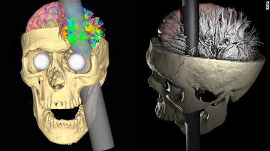 Phineas Gage skull model showing the path of the iron rod